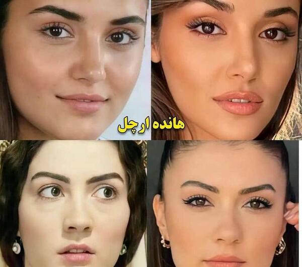 عکس های قبل از عمل اوزگه یاگیز