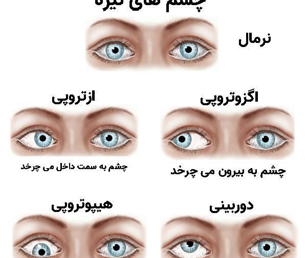 عکس چشم های آسیب دیده