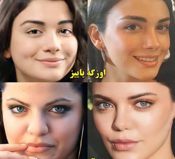عکس هانده ارچل جدید قبل از عمل