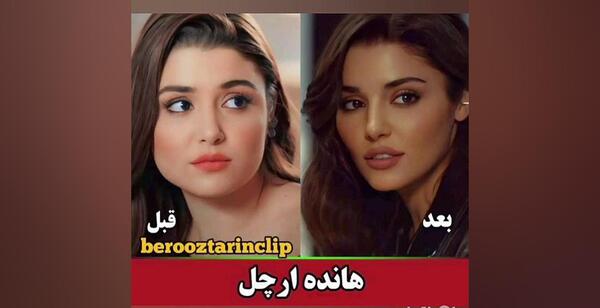 عکس های هانده ارچل بعد از عمل