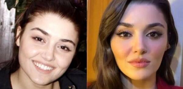 عکس قبل و بعد از عمل زیبایی هانده ارچل