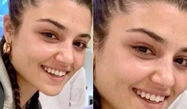 عکس های هانده ارچل قبل عمل