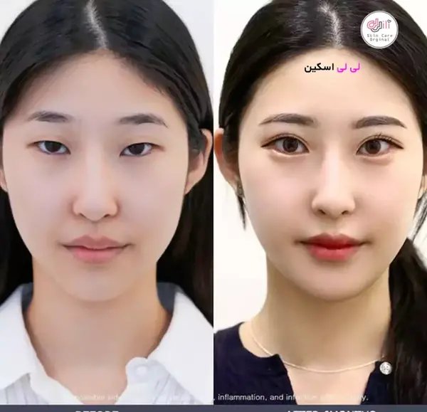 عکس چشم کره ای ها