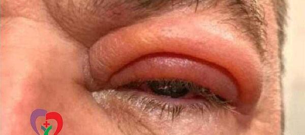 عکس از چشم عفونت کرده
