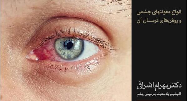 عکس از چشم عفونت کرده