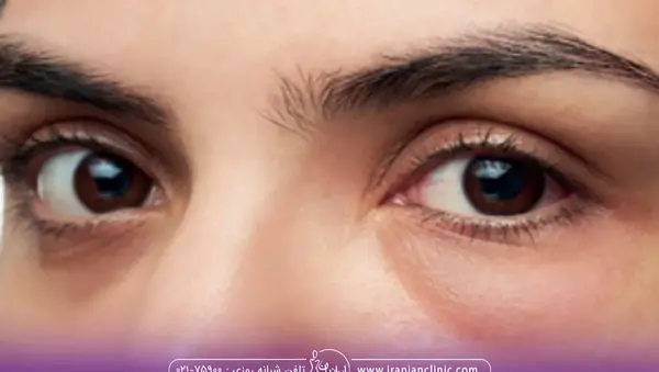 عکس آدم چشم سیاه