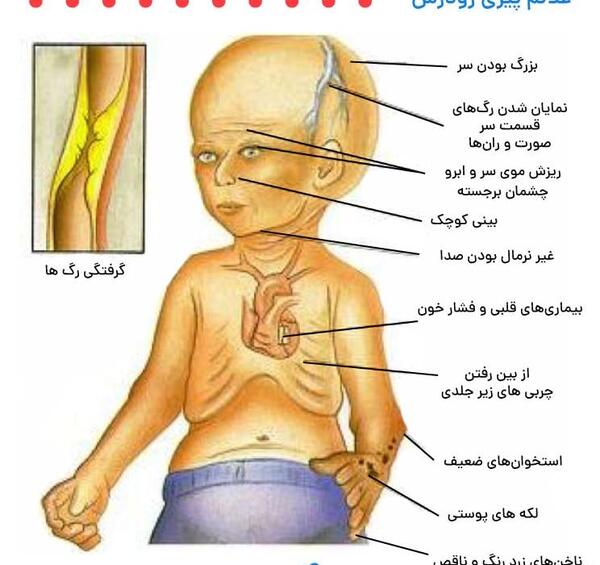 عکس بیماری پیری زودرس