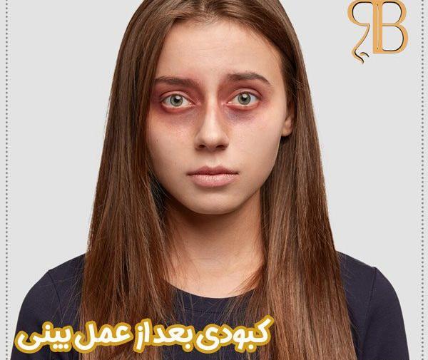 عکس های کبودی