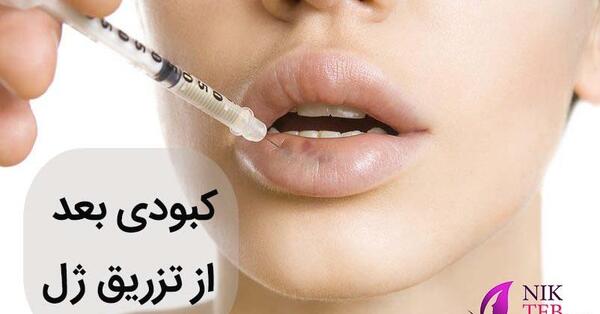 عکس کبودی دور لب