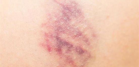 عکس کبودی بی دلیل بدن