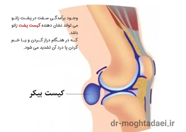 عکس کبودی پشت زانو