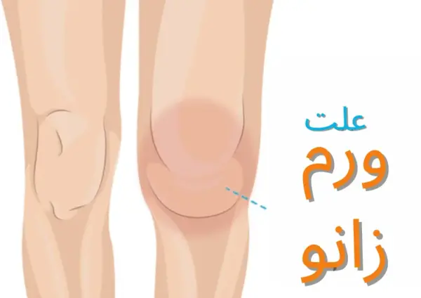 عکس کبودی پشت زانو