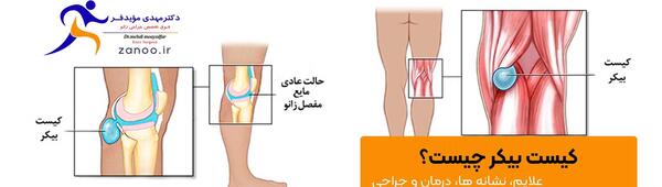 عکس کبودی پشت زانو