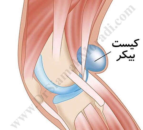 عکس کبودی پشت زانو