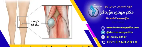 عکس کبودی پشت زانو