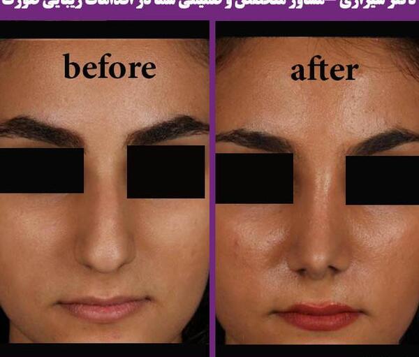 عکس عمل بینی دکتر کبودخانی