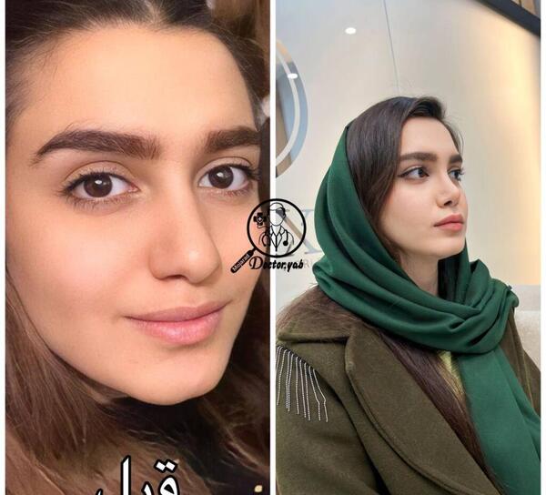 عکس عمل بینی دکتر کبودخانی