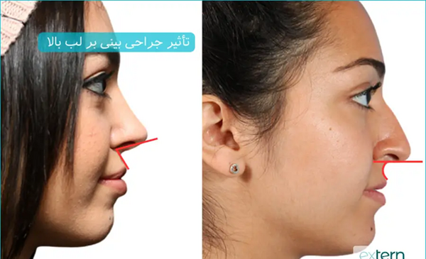 عکس عمل بینی دکتر کبودخانی