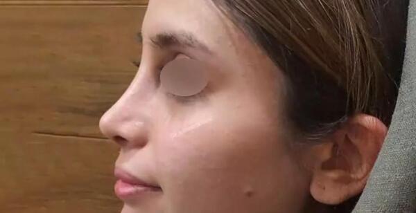 عکس عمل بینی دکتر کبودخانی