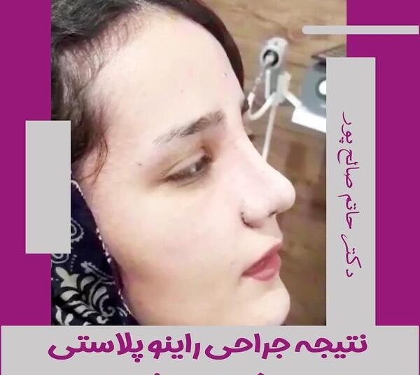 عکس عمل بینی دکتر کبودخانی