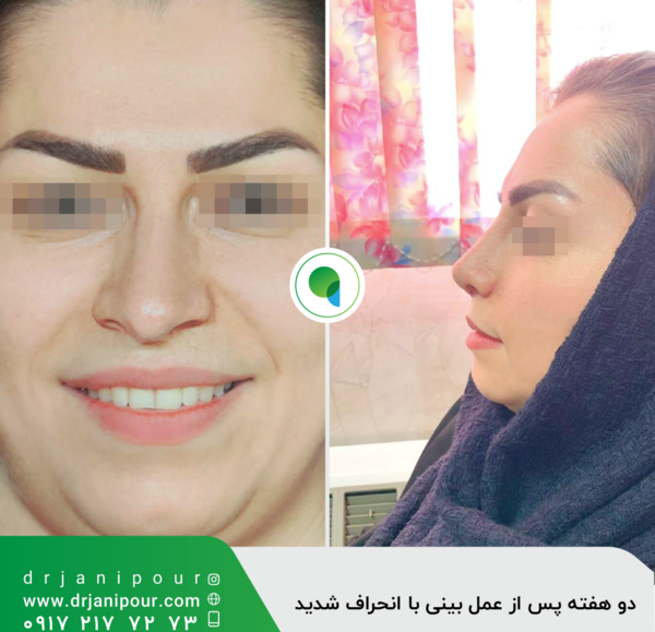 عکس عمل بینی دکتر کبودخانی