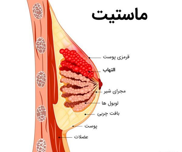 عکس کبودی های سرطان خون نی نی سایت