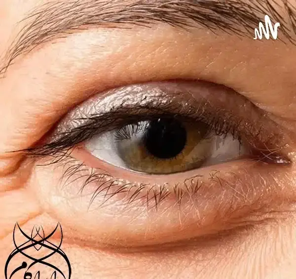 عکس از کبودی چشم