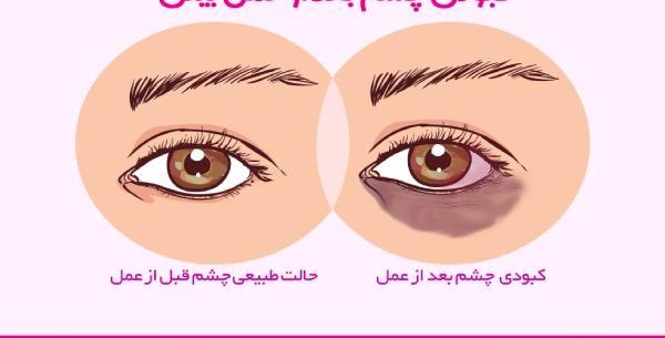عکس از کبودی چشم