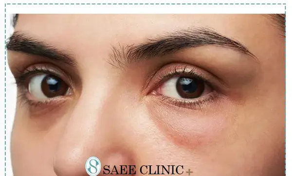 عکس از کبودی چشم