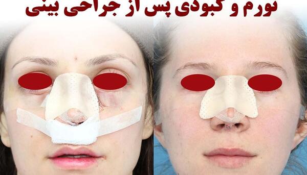 عکس از کبودی چشم