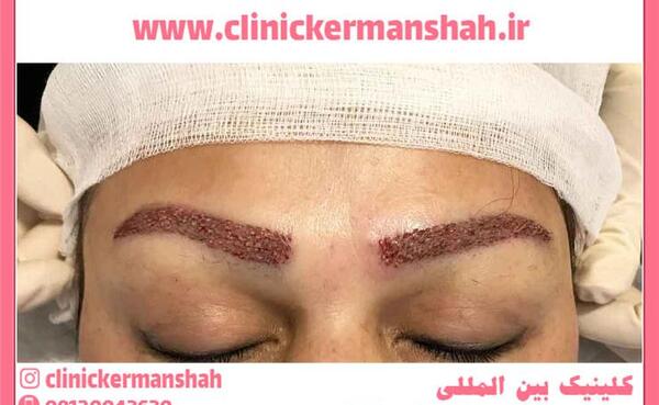 عکس از کبودی چشم