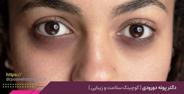 عکس از کبودی چشم