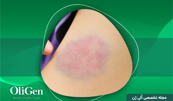 عکس دست کبود شده جای سرم