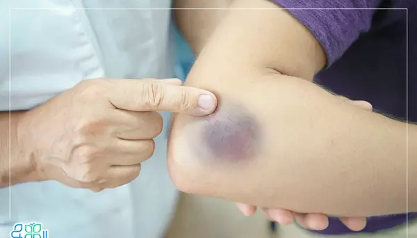 عکس دست کبود شده جای سرم