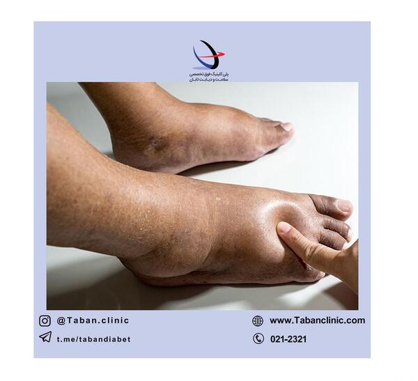 عکس ساق پای کبود شده