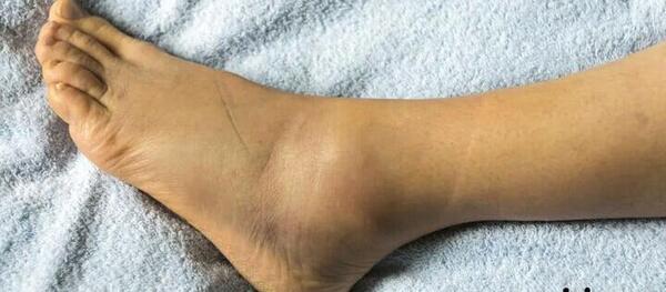 عکس ساق پای کبود شده