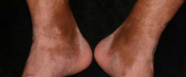 عکس از پای کبود شده