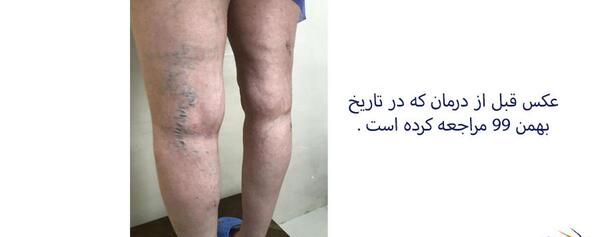عکس کبودی بدن دختر
