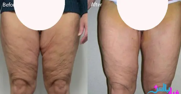 عکس کبودی ران پا نی نی سایت