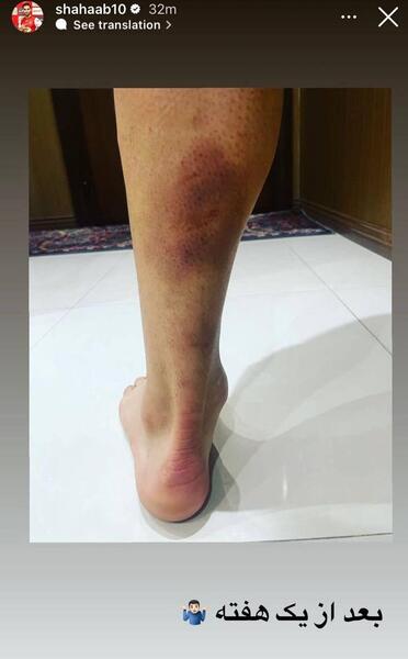 عکس کبودی پای زن