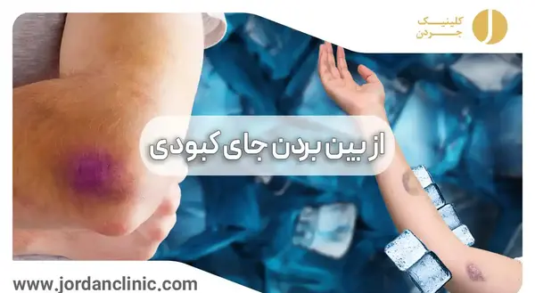 عکس کبودی گردن در اثر مکیدن