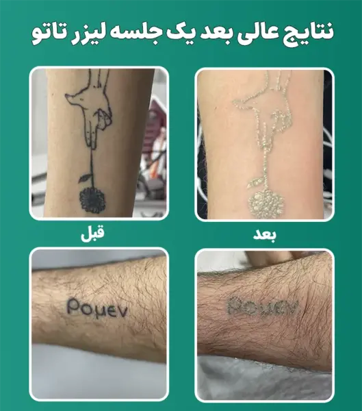 عکس تاتو لب گاز گرفته