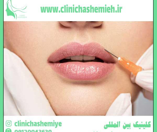 عکس تاتو لب گاز گرفته