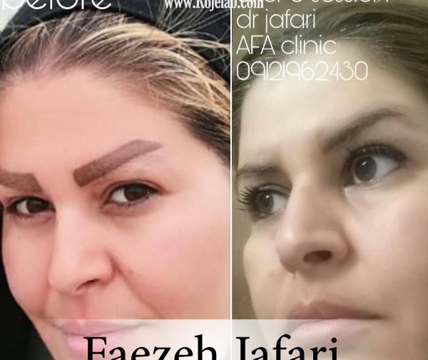 عکس قبل و بعد لیزر تاتو ابرو