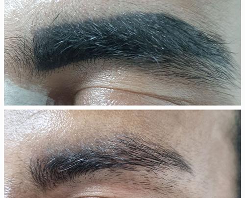 عکس قبل و بعد لیزر تاتو ابرو