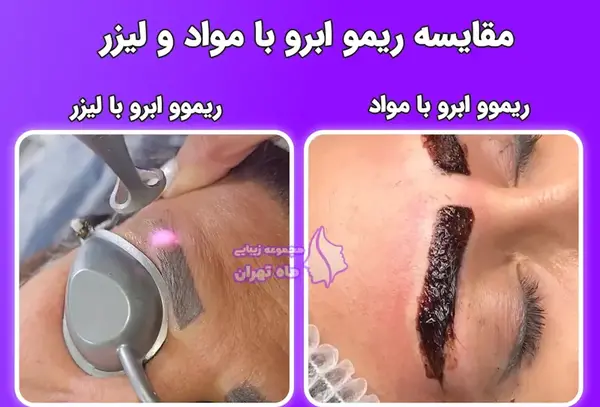 عکس قبل و بعد لیزر تاتو ابرو