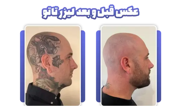 عکس قبل و بعد لیزر تاتو ابرو