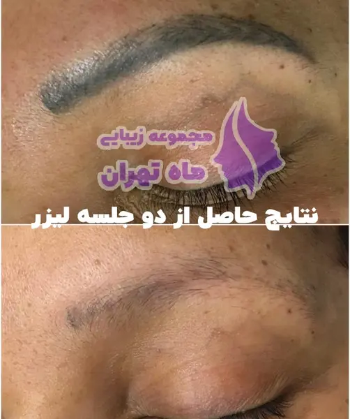 عکس قبل و بعد لیزر تاتو ابرو
