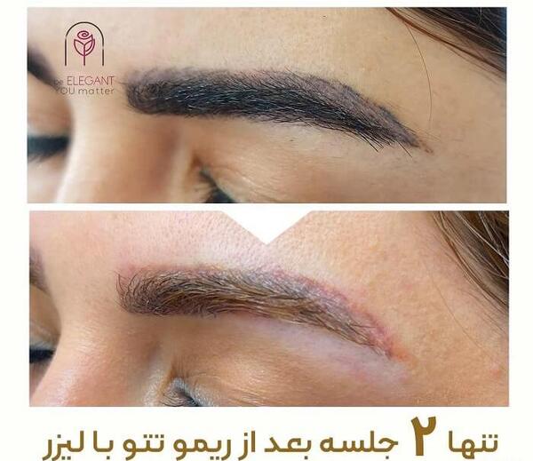 عکس قبل و بعد لیزر تاتو ابرو