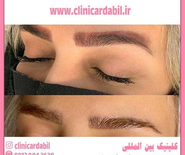 عکس قبل و بعد لیزر تاتو ابرو